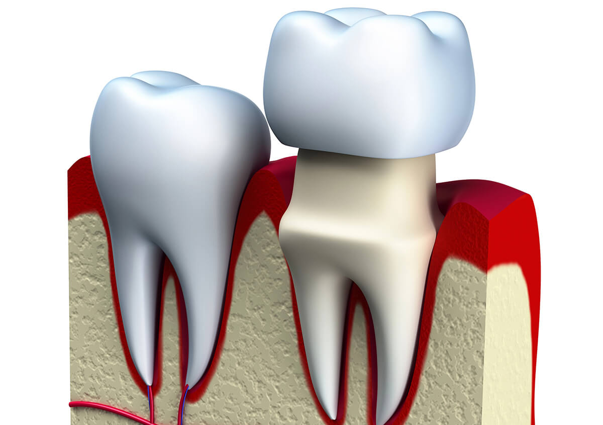 Schedule a Dental Crown Procedure Today to Fix Chipped or Cracked Teeth