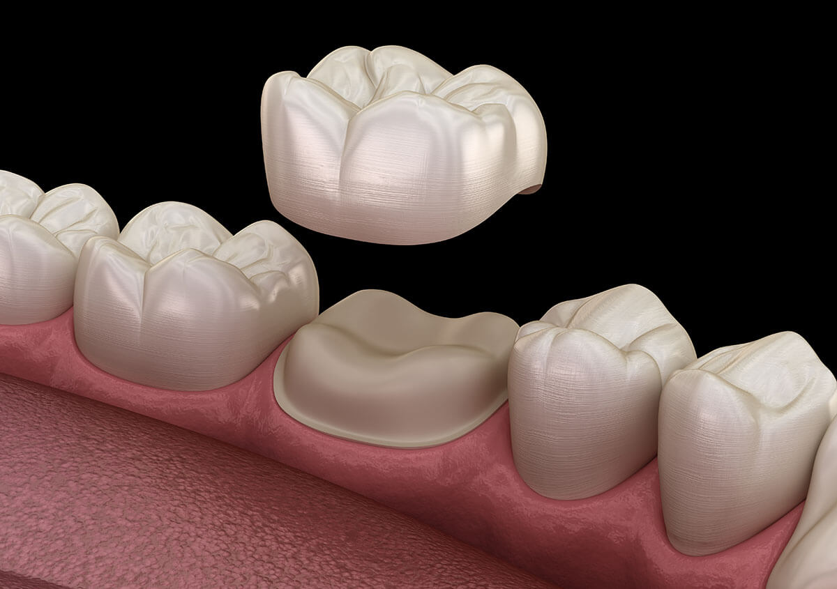 Damaged Tooth? Restore Its Function and Beauty with a Porcelain Crown