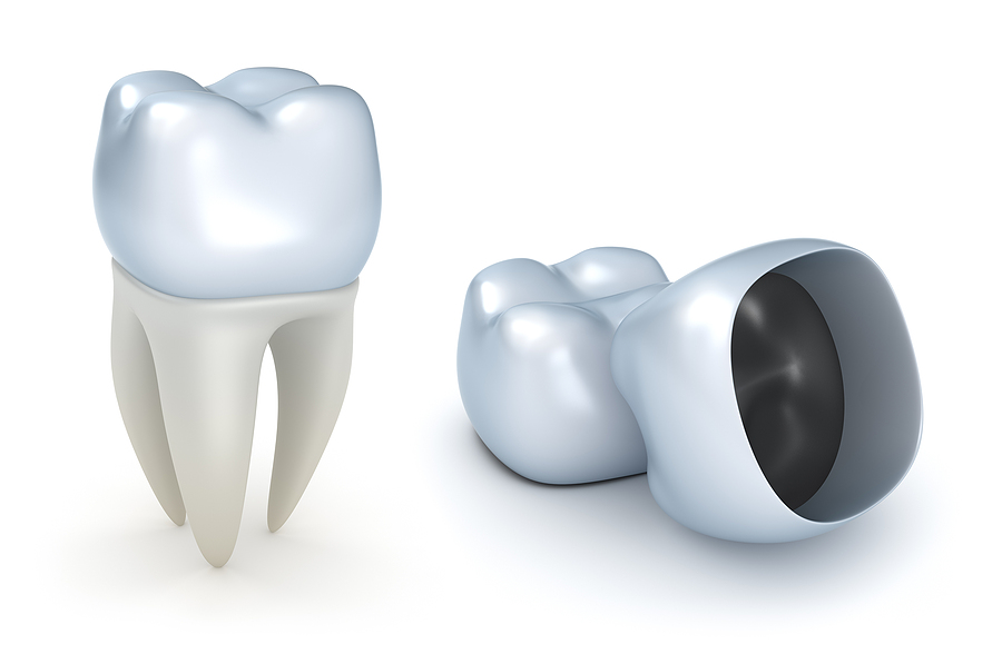 Everything You Need to Know About Dental Crowns in Newnan, GA